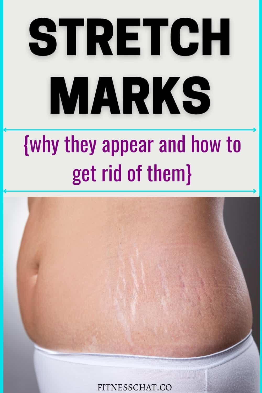 how to remove stretch marks fast