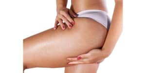 how to get rid of stretch marks fast and home remedies for stretch marks